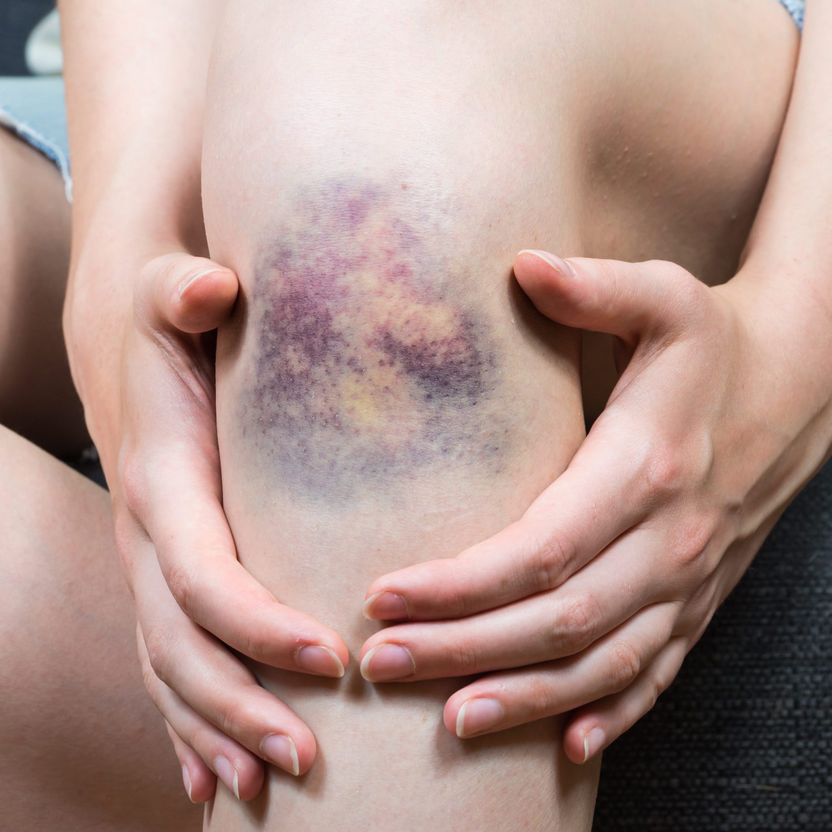 Bruise,Injury,On,Young,Woman,Knee.,Close,Up,Image,Of